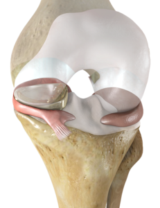 nusurface-meniscus-implant