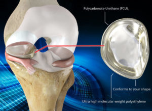 active-implants-nusurface-knee-implant